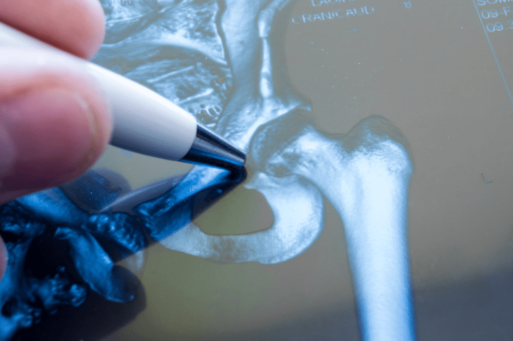 Joint Replacement In India Doesn’t Have To Be Hard. Read This