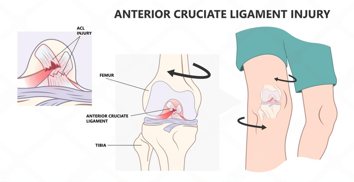 ACL Reconstruction in Delhi - arthroscopic ligament surgery