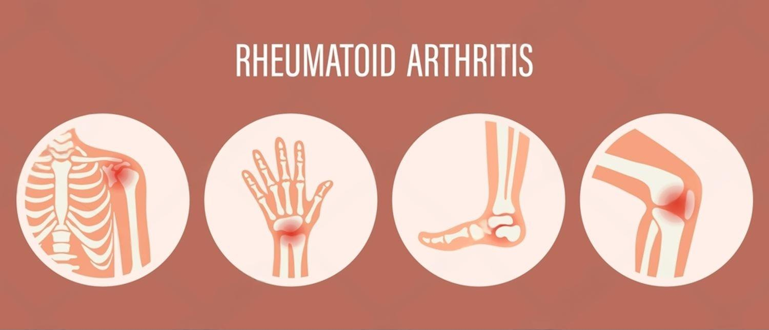 Arthritis and Rheumatology Care in Delhi - comprehensive evaluation and treatment