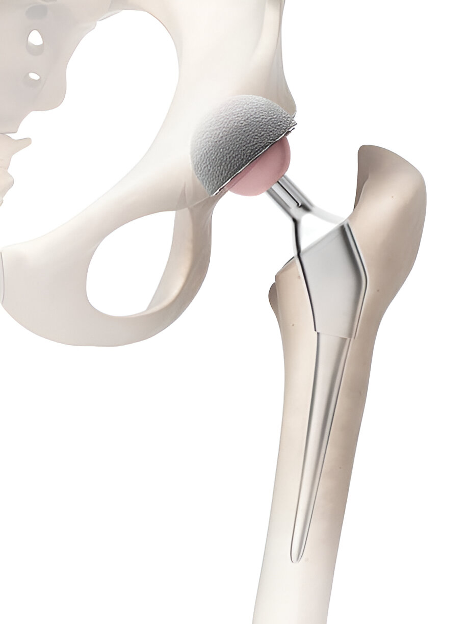 Bipolar partial hip replacement implant diagram - stem and modular head