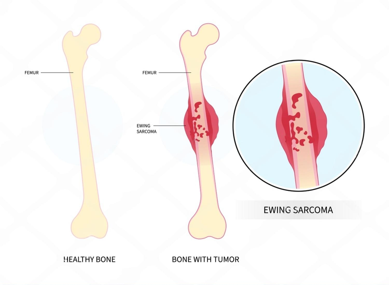 Bone Tumor Surgery in Delhi - limb-salvage resection and reconstruction
