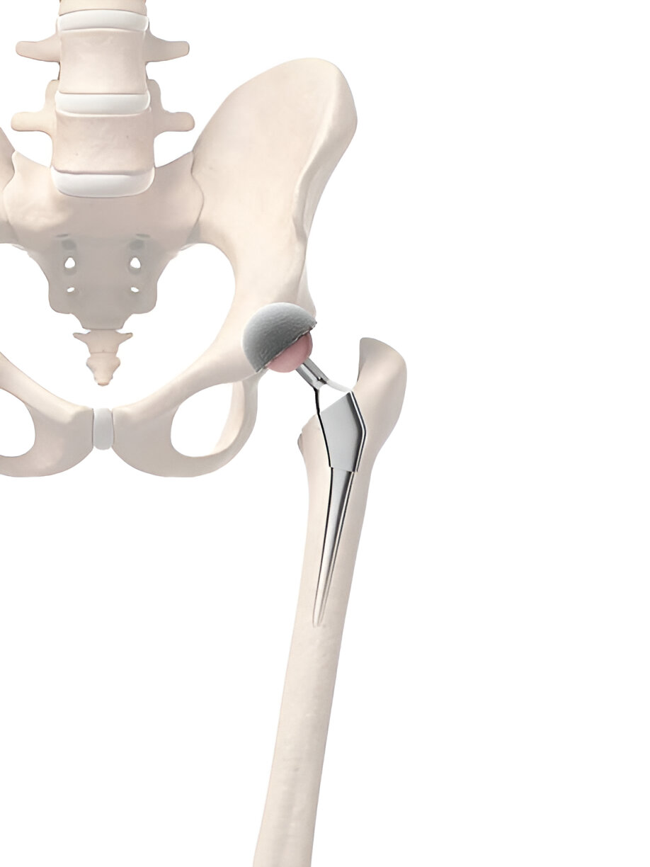 Cemented or uncemented stem with bipolar head for partial hip replacement - Delhi
