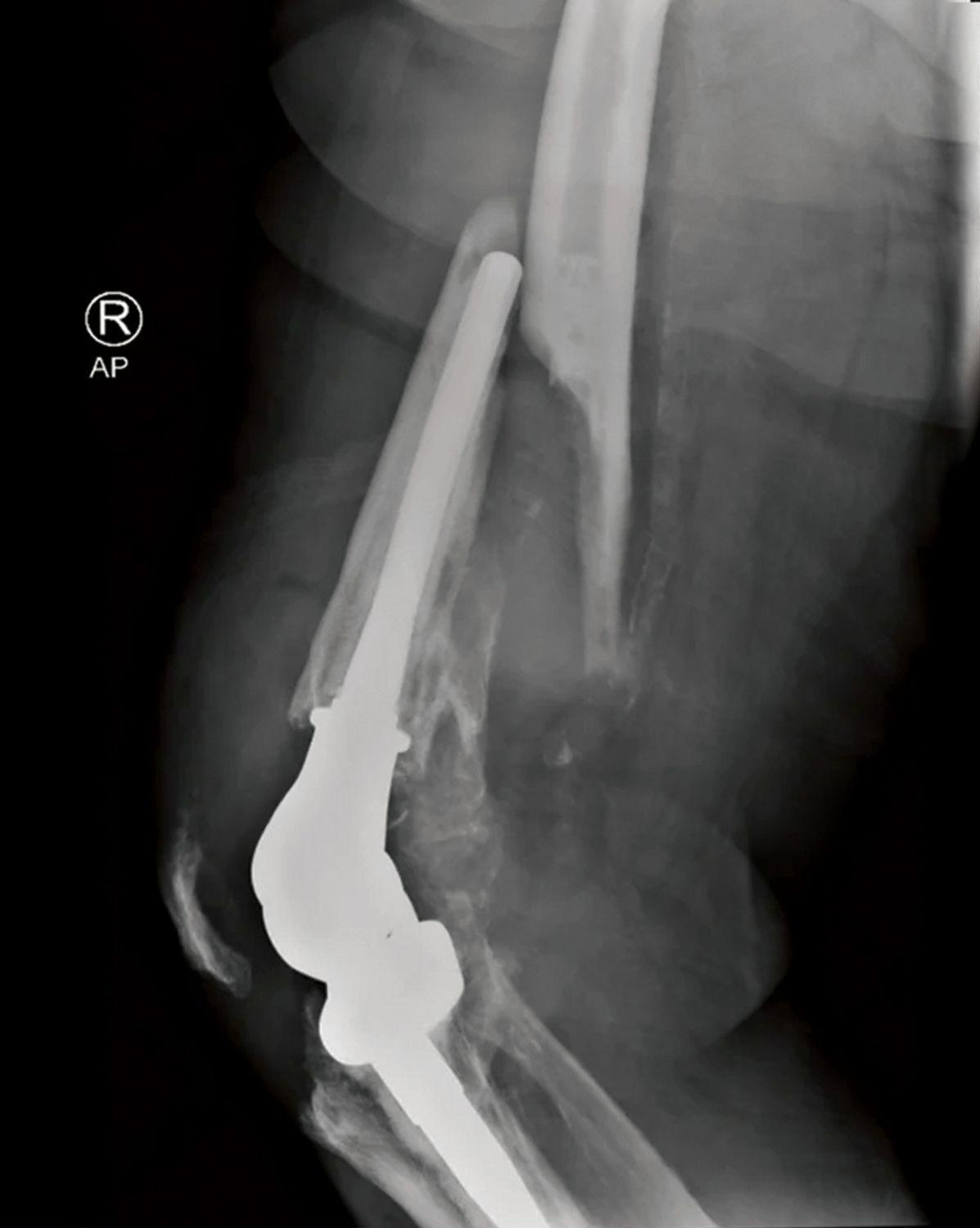 Limb-salvage with modular tumor endoprosthesis reconstruction - Delhi
