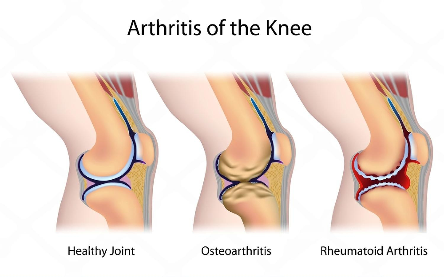 Overview of arthritis types - osteoarthritis, rheumatoid arthritis, gout, spondyloarthritis