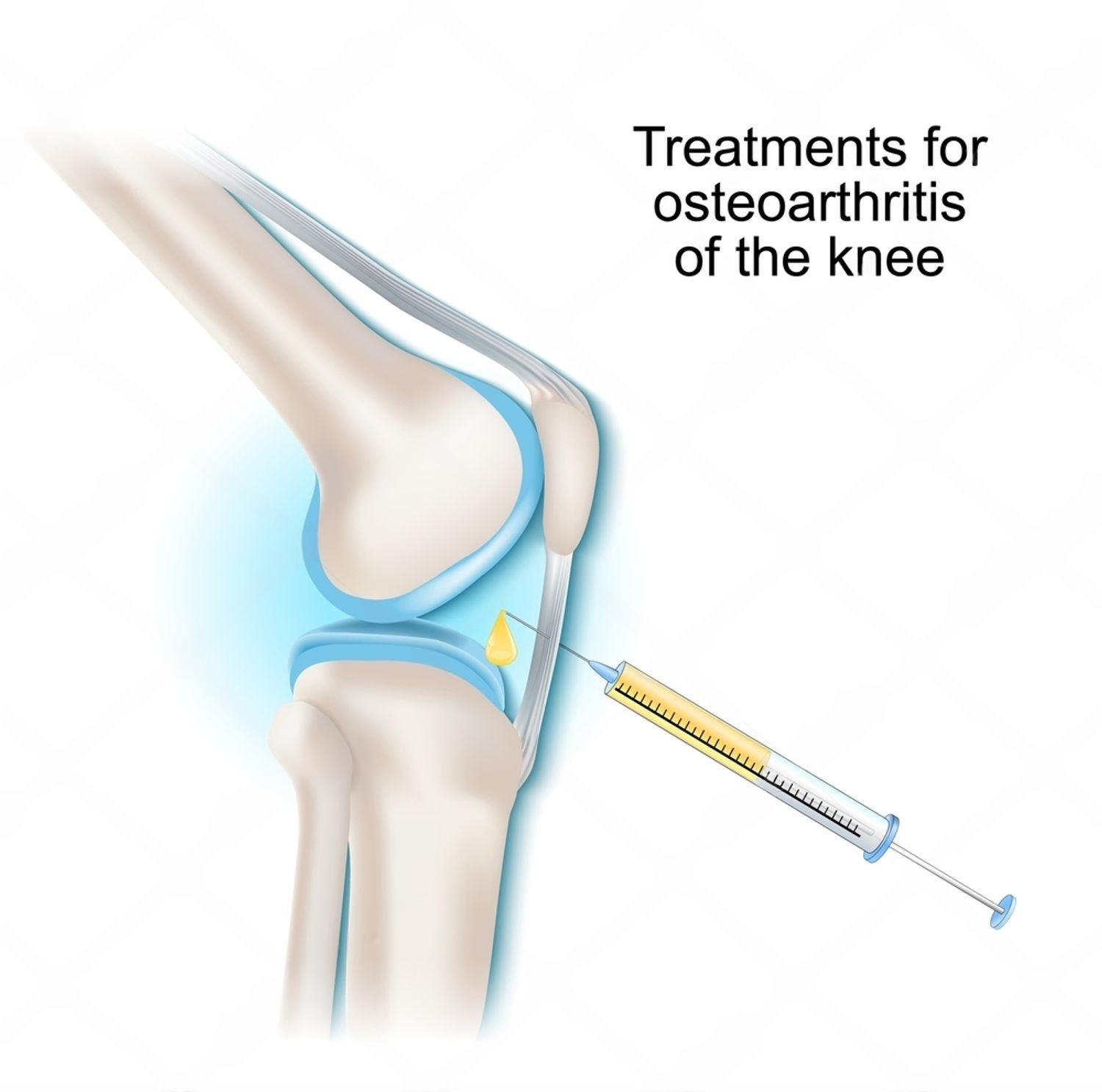Targeted joint injection therapy in Delhi (non‑PRP)