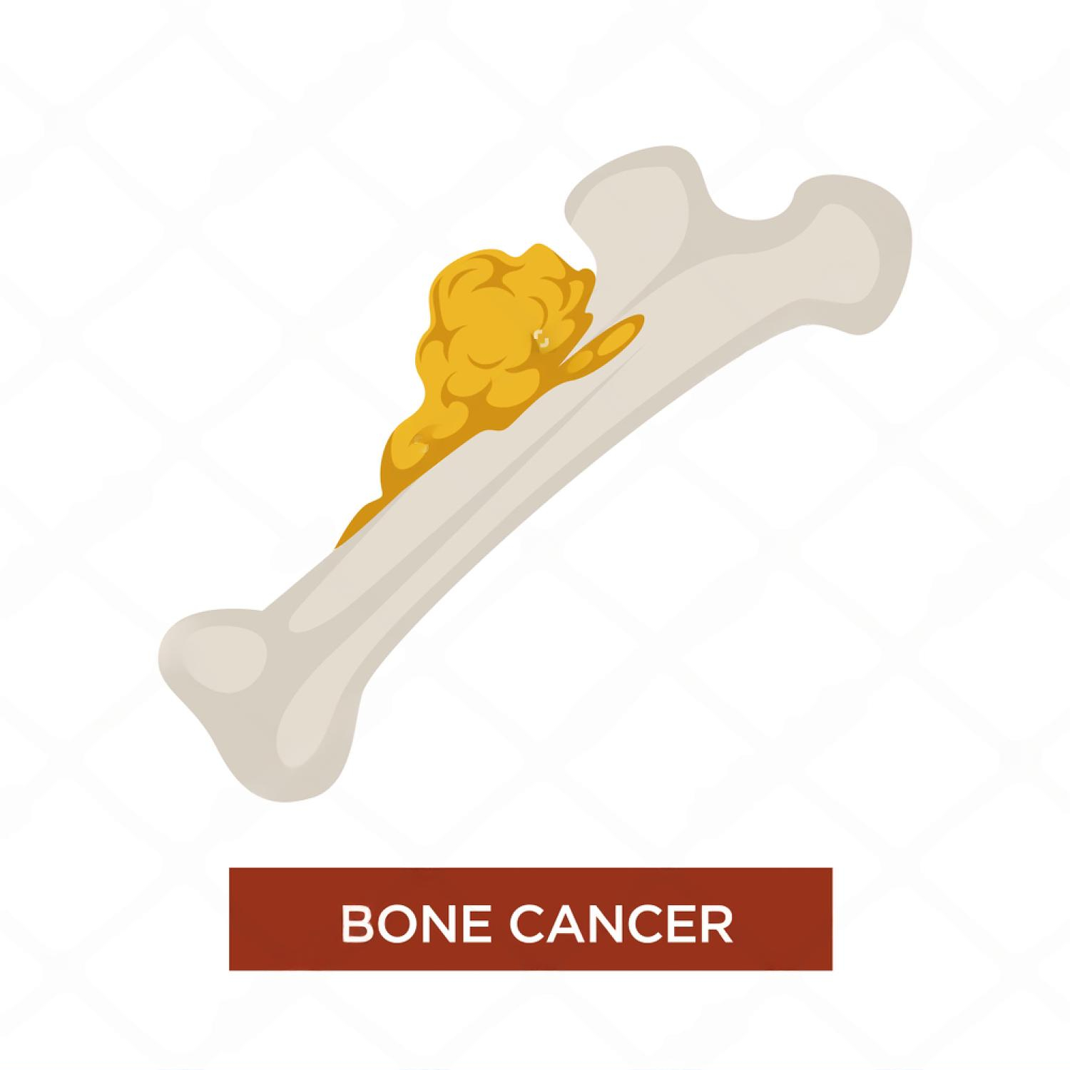 Types of bone tumors - benign, aggressive benign, malignant
