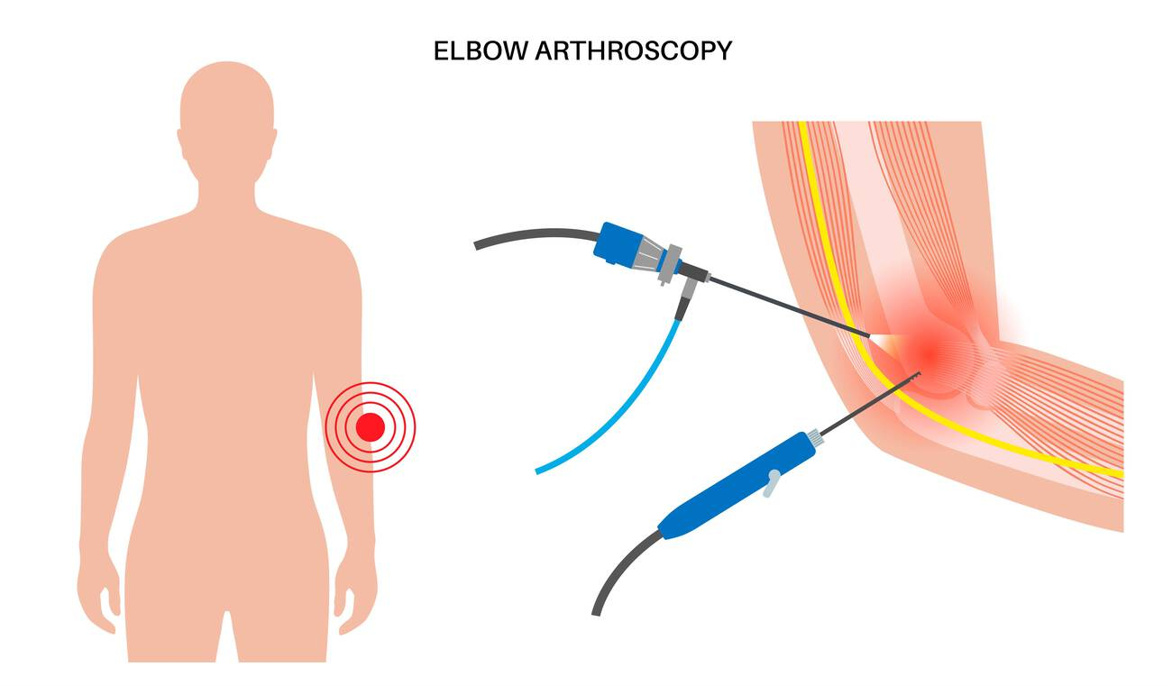 Arthroscopic Surgery in Delhi - keyhole camera treating knee and shoulder