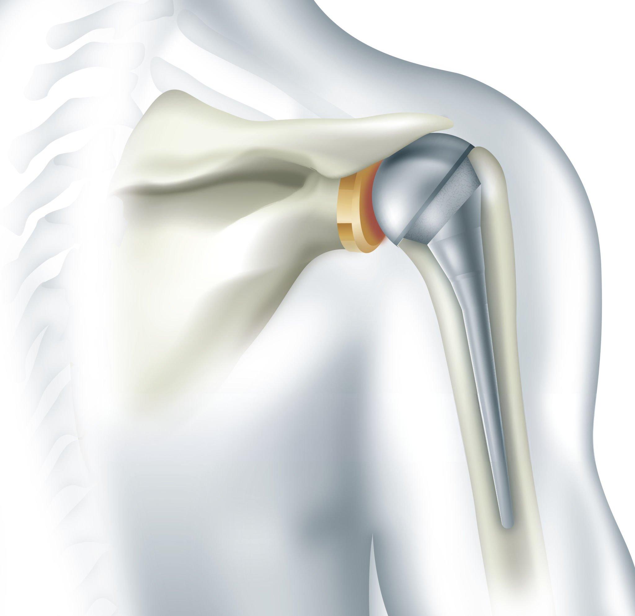 Shoulder Replacement in Delhi implant diagram - anatomic and reverse components
