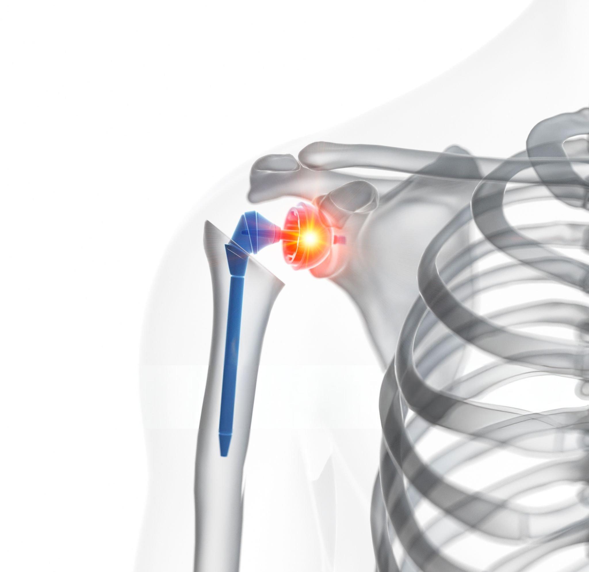 Shoulder Replacement in Delhi - patient moving shoulder comfortably after surgery
