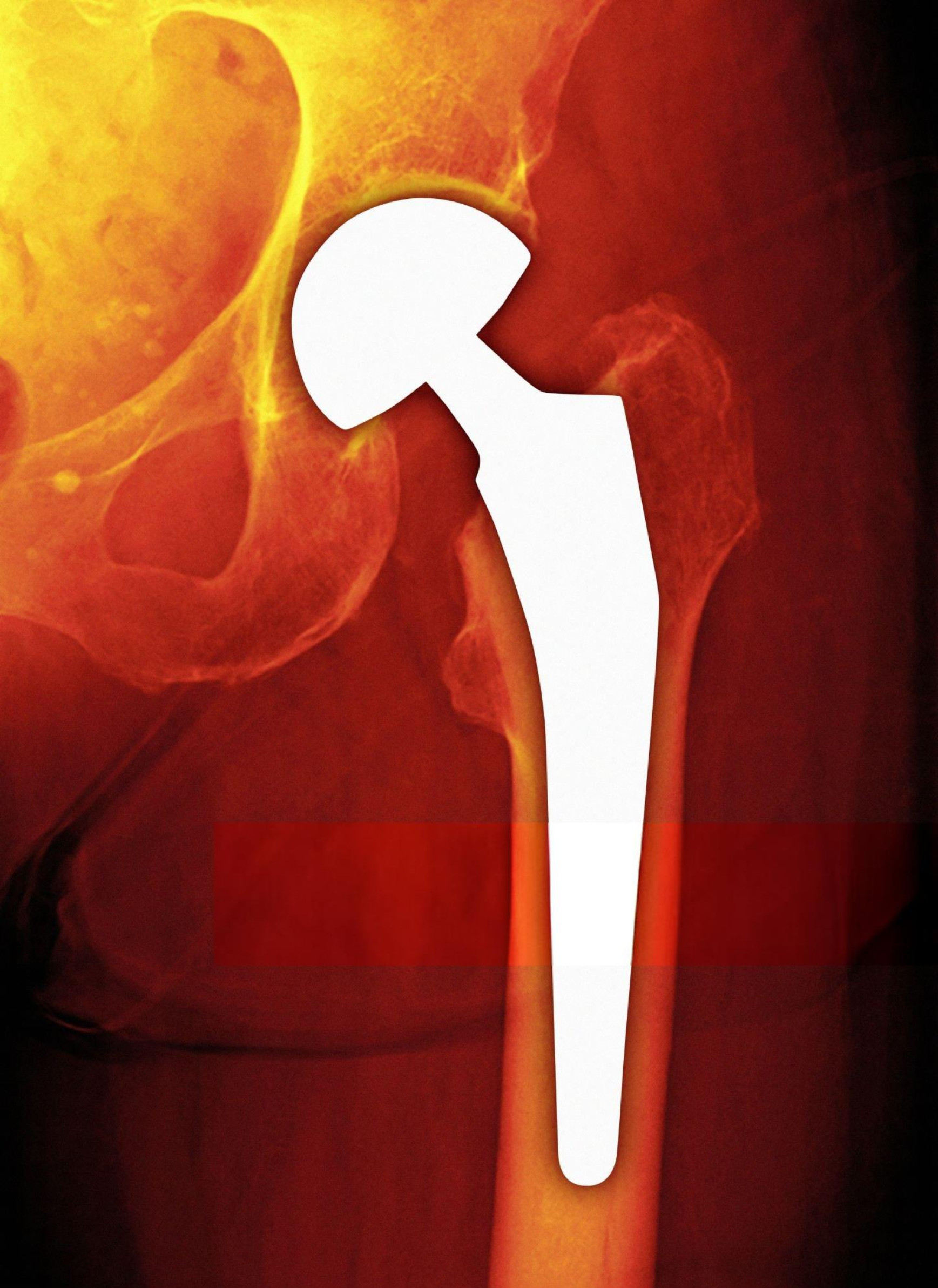 Total Hip Replacement in Delhi - patient walking after hip replacement
