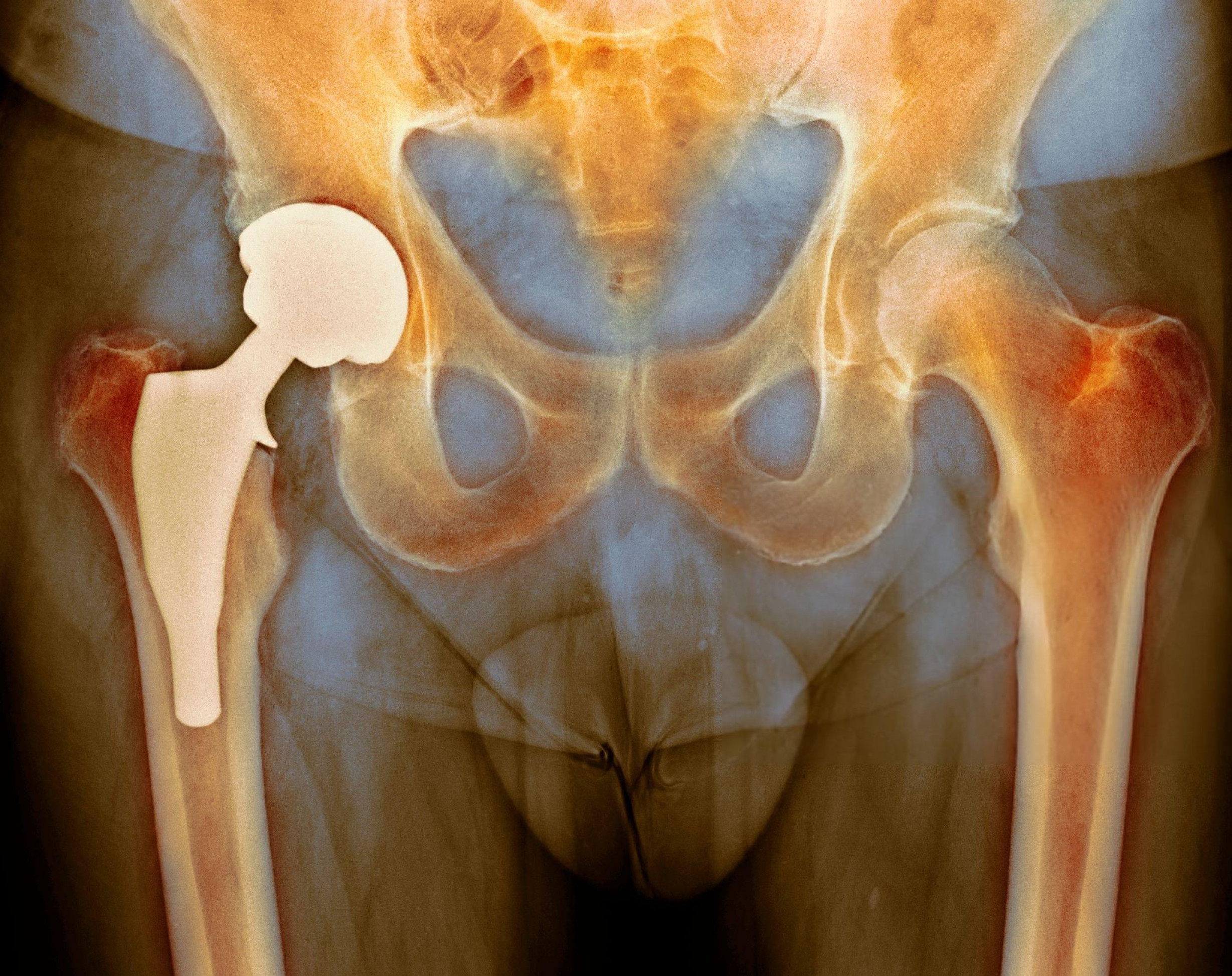 Total Hip Replacement in Delhi implant components - acetabular cup, liner, femoral stem and head