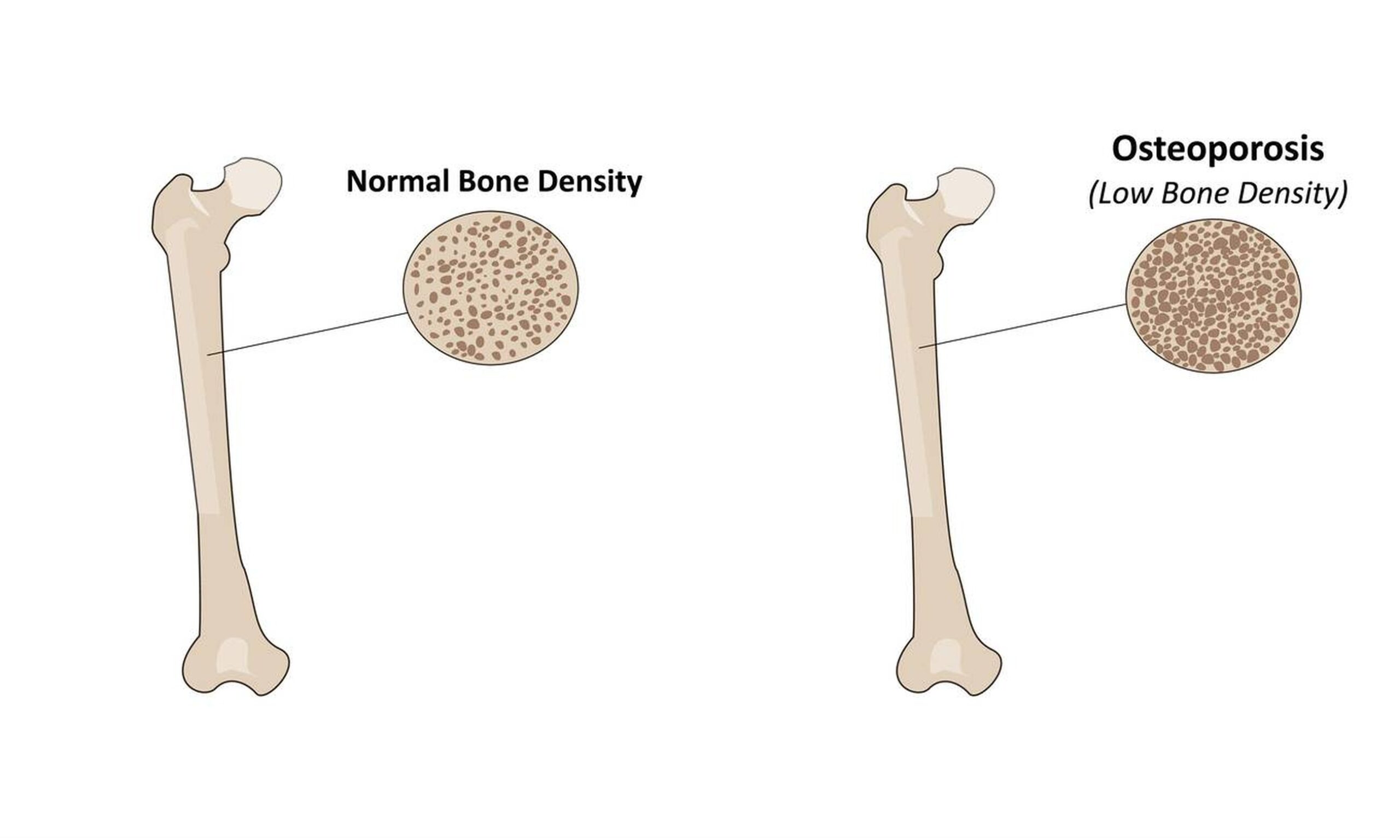 Osteoporosis and Metabolic Bone Disease in Delhi - bone health care