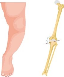 Guided growth plates for angular correction in children - Delhi