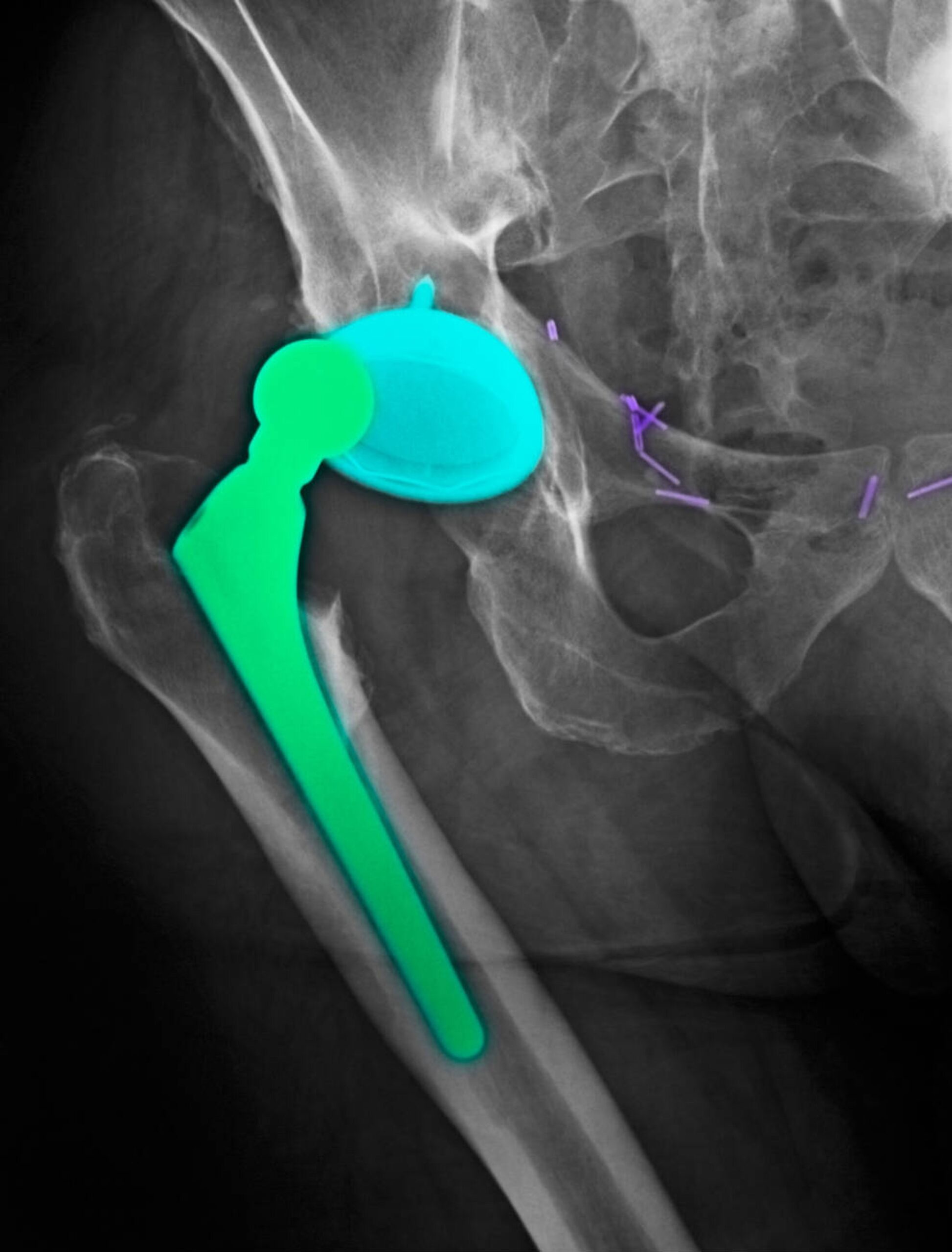 Hip replacement in Karol Bagh, Delhi‑NCR — modern implant and precise alignment