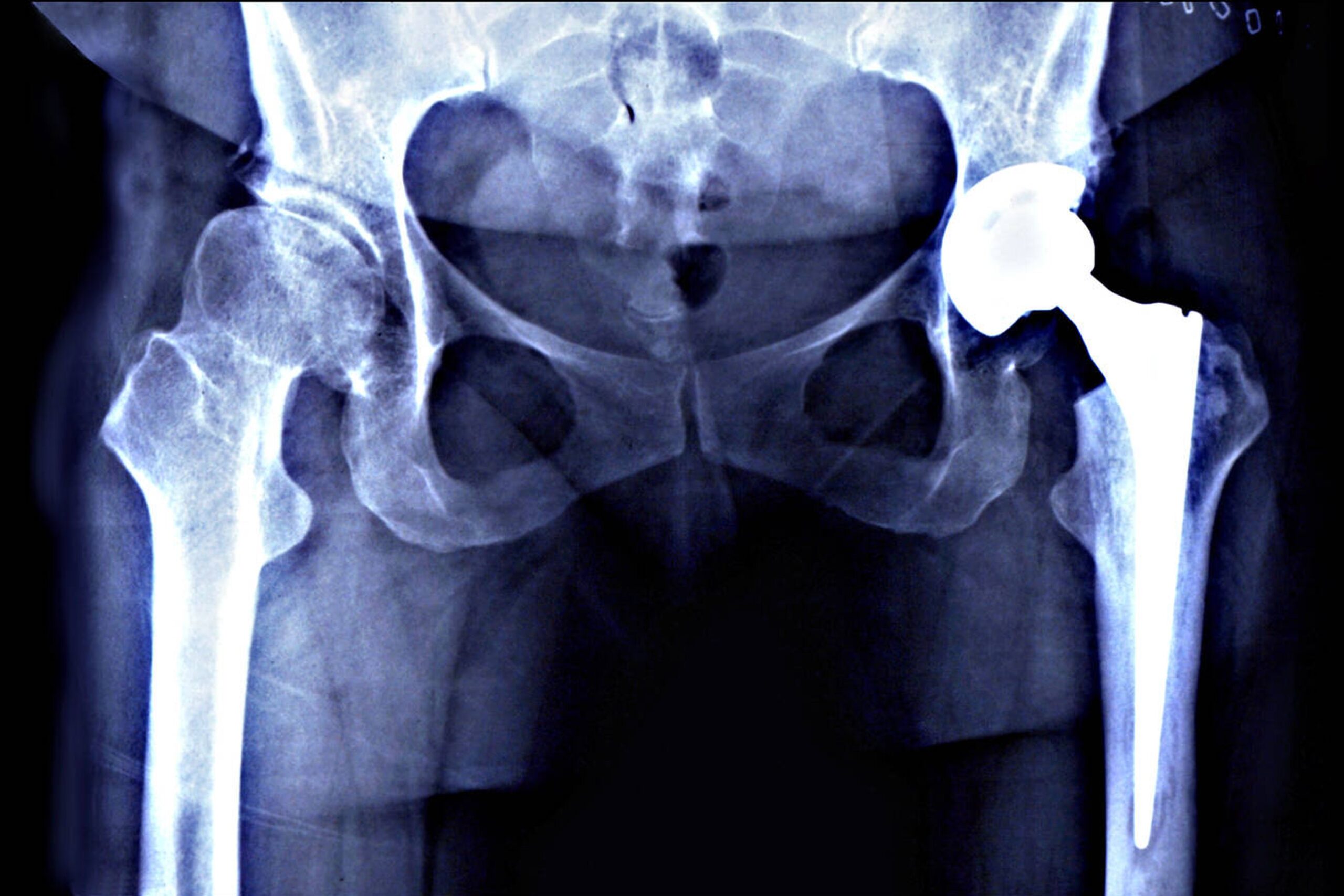 Hip replacement recovery week by week timeline – key milestones