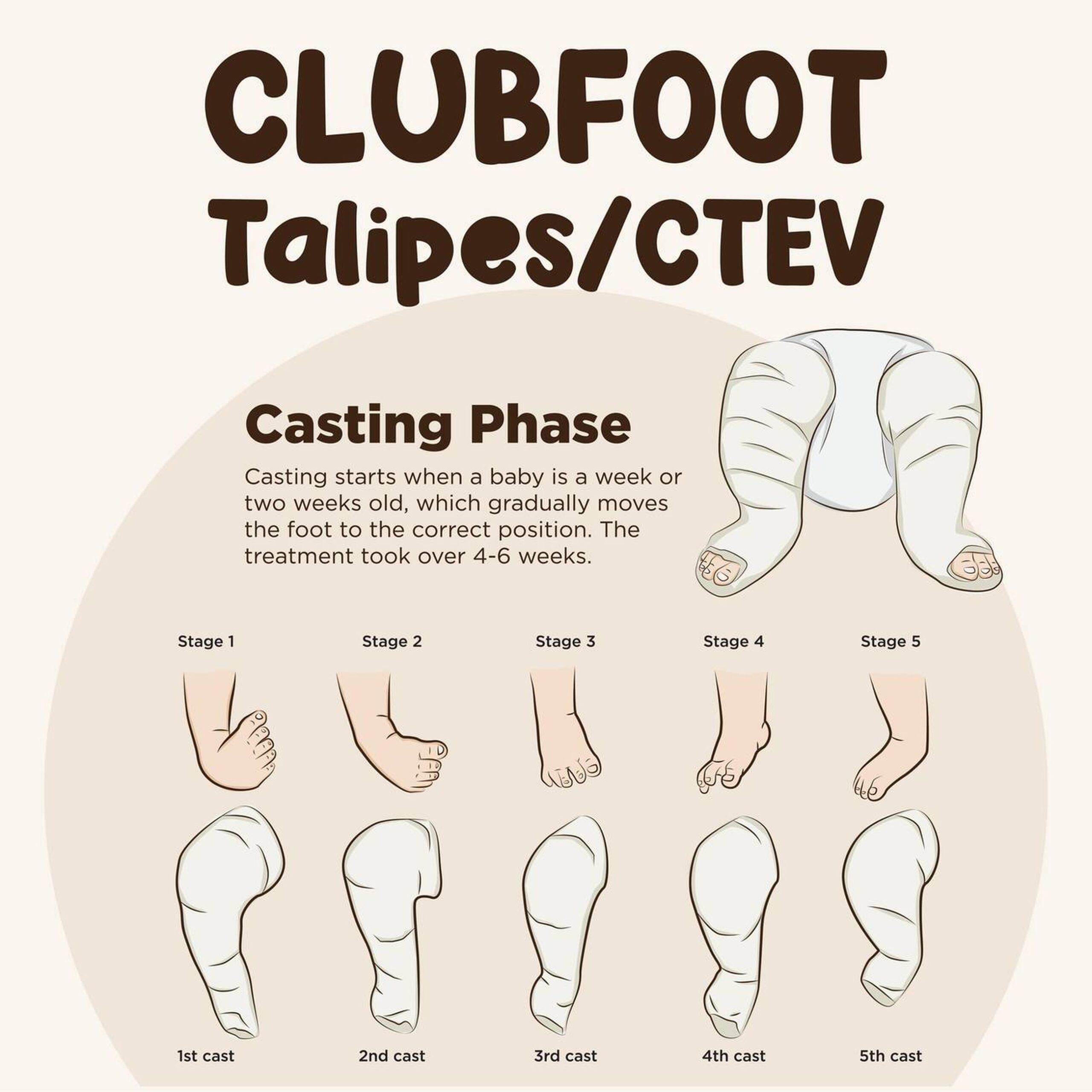 Ponseti casting for clubfoot in Delhi