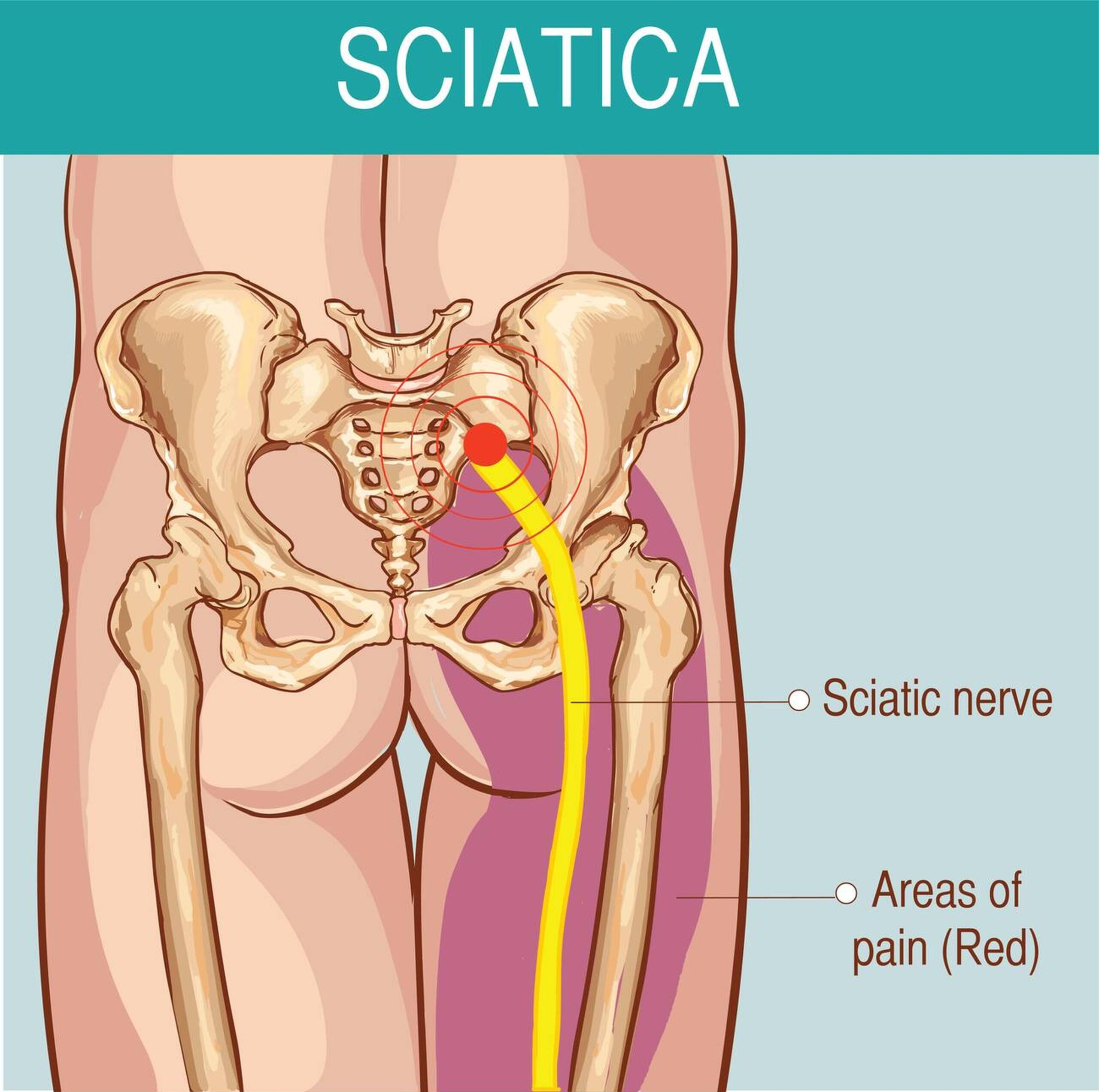 Diagram showing the path of the sciatic nerve from the lower back down the leg.