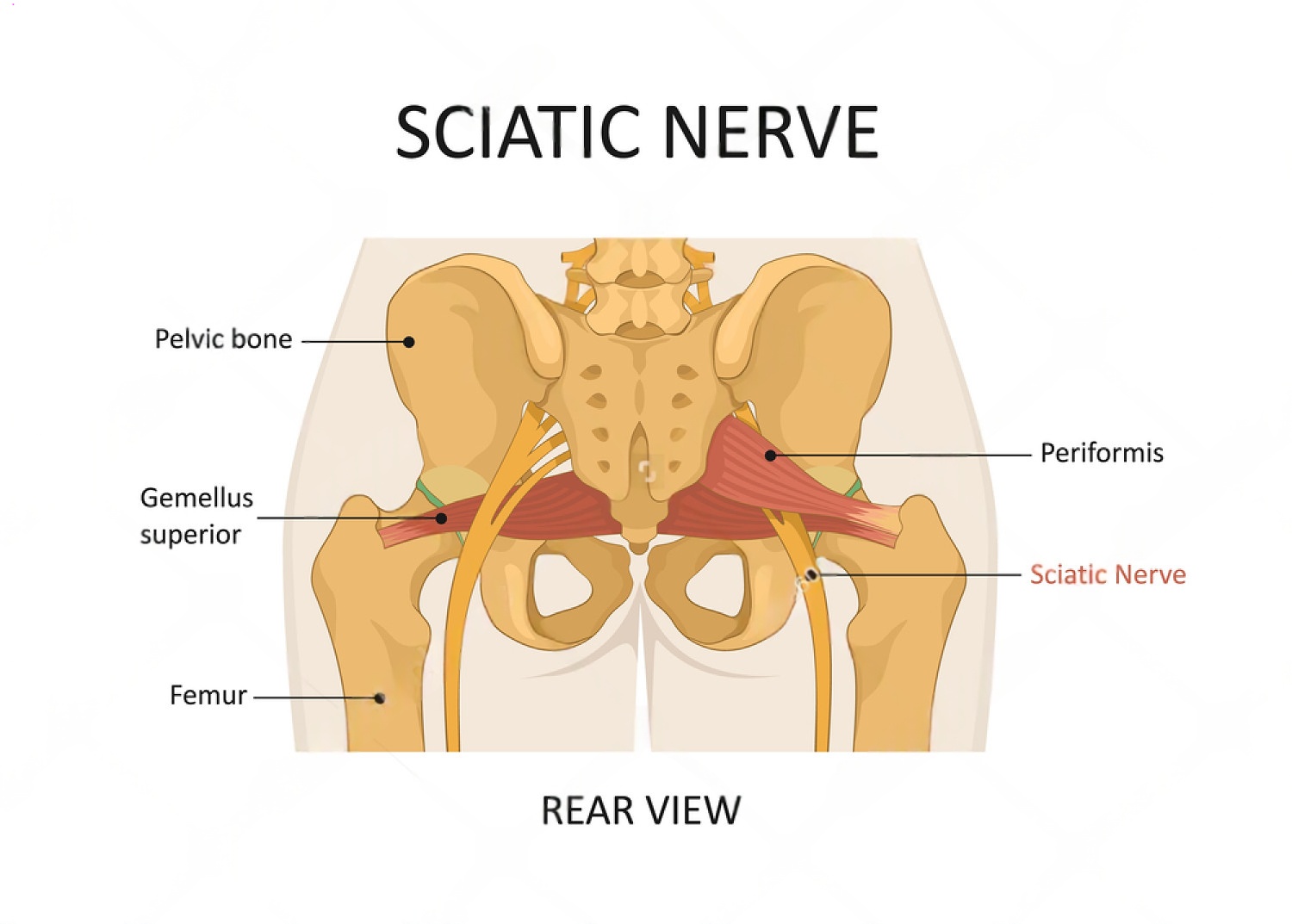 Sciatic nerve diagram and common compression sites - Delhi