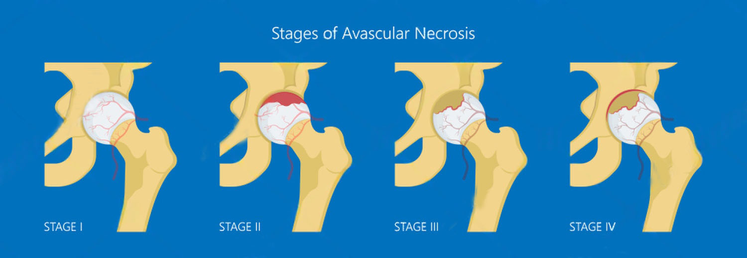 Avascular necrosis of the hip (osteonecrosis) showing progression