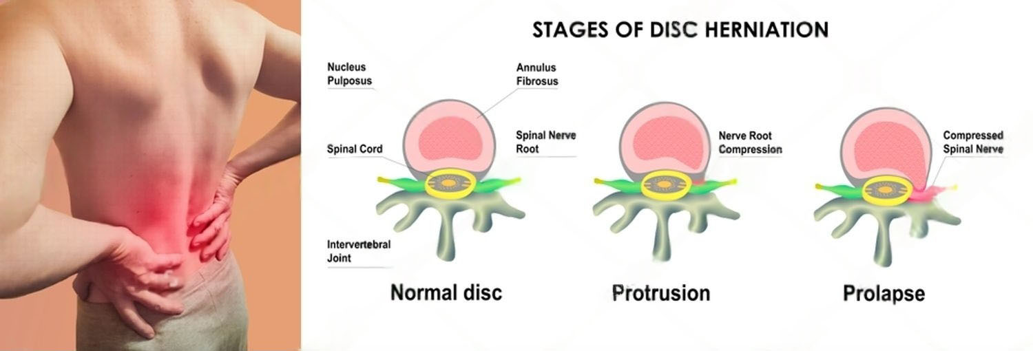 prolapsed intervertebral disc (PIVD) herniated disc overview