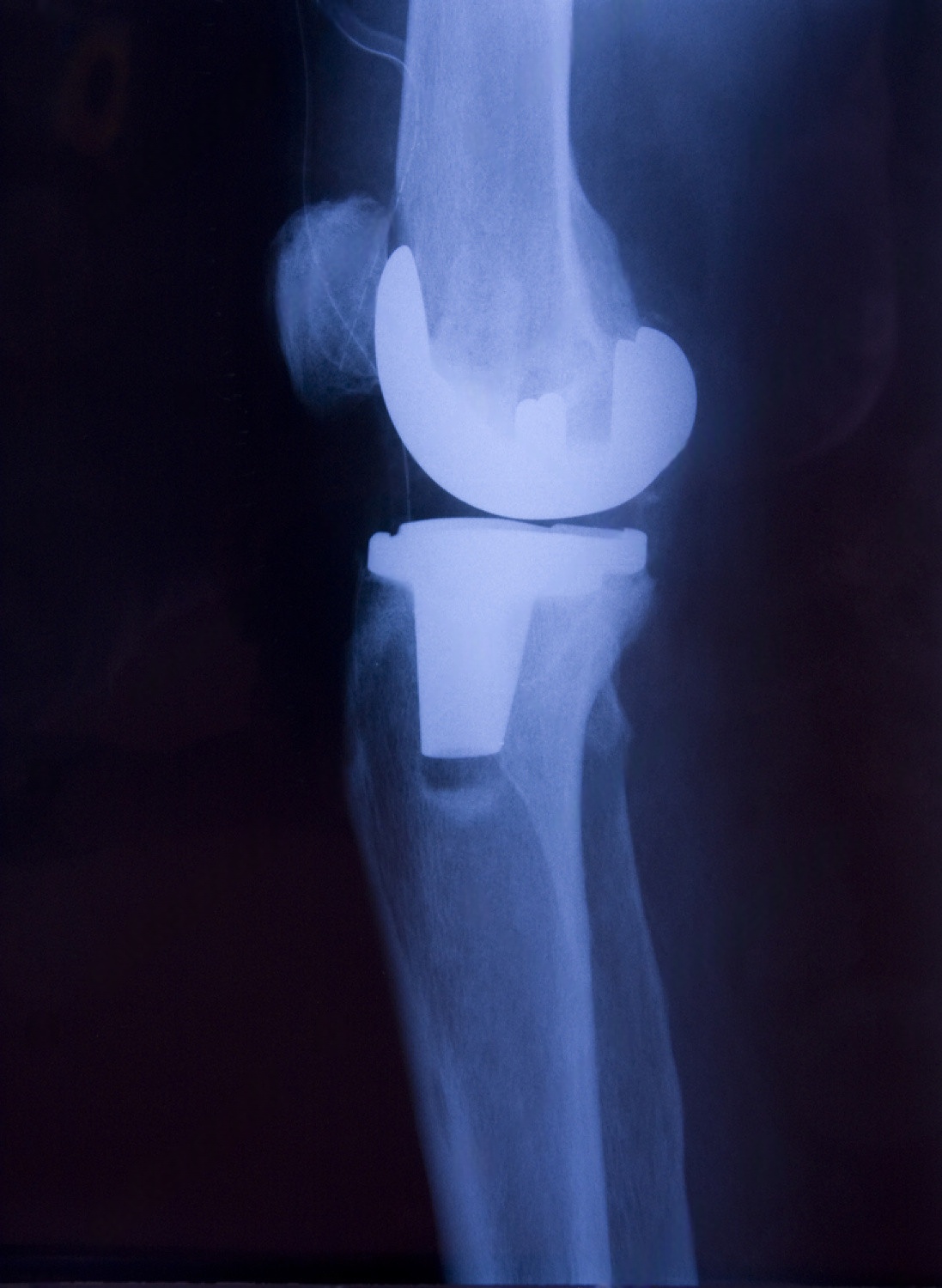 knee joint replacement surgery cost in india – price factors and packages