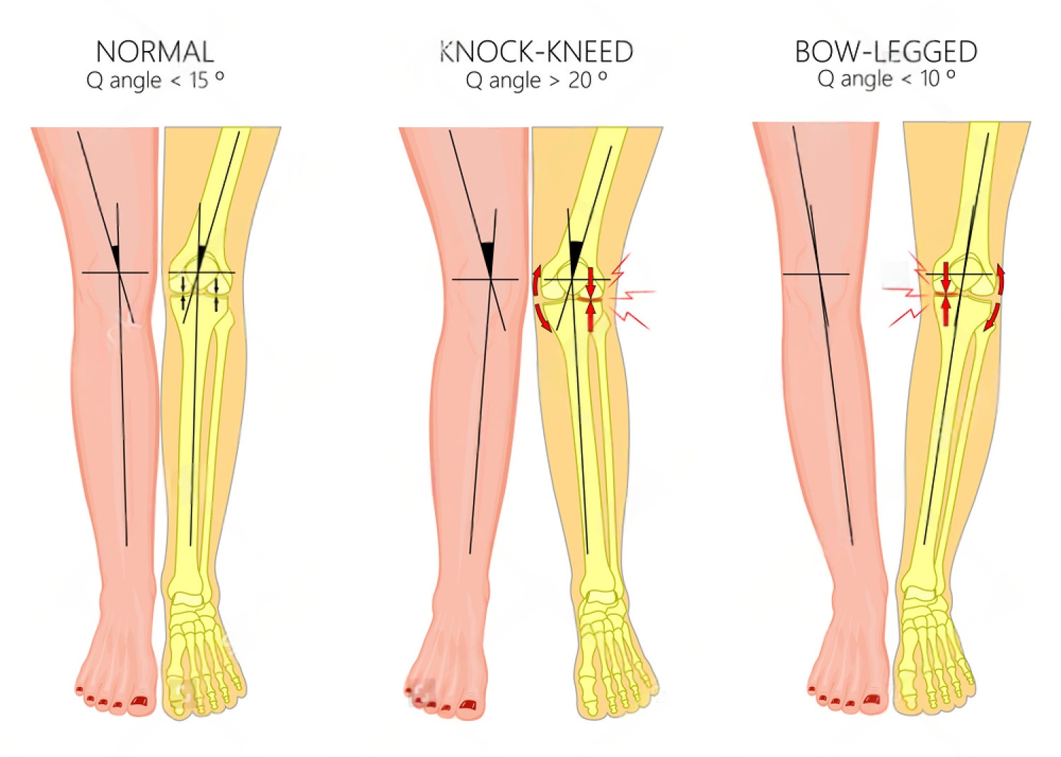 knock knees (genu valgum) causes symptoms diagnosis and treatment