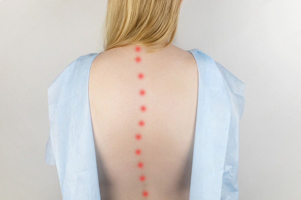 Anesthesia and multimodal pain strategy — scoliosis surgery in Delhi