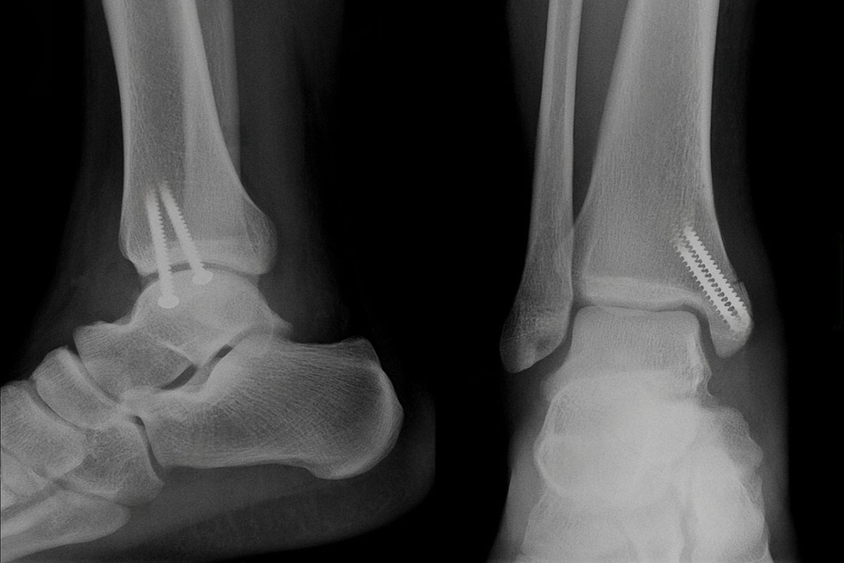 Ankle arthroscopy for impingement and osteochondral lesion of the talus in Delhi