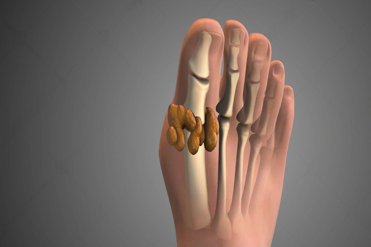 Bunion (hallux valgus) correction planning with osteotomy and soft-tissue balancing in Delhi