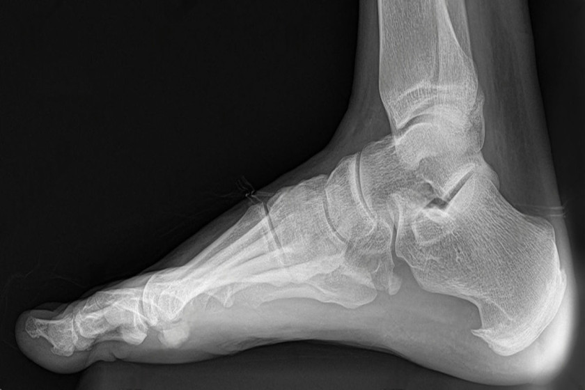 Flatfoot (PTTD) reconstruction with calcaneal osteotomy and tendon transfer in Delhi