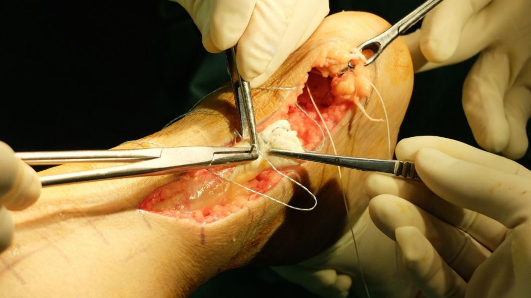 Foot and Ankle Surgery in Delhi - bunion, flatfoot, instability, Achilles, arthroscopy