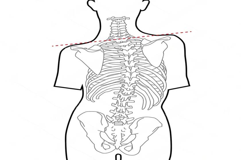 Cost and insurance guidance — scoliosis and spine deformity surgery in Delhi