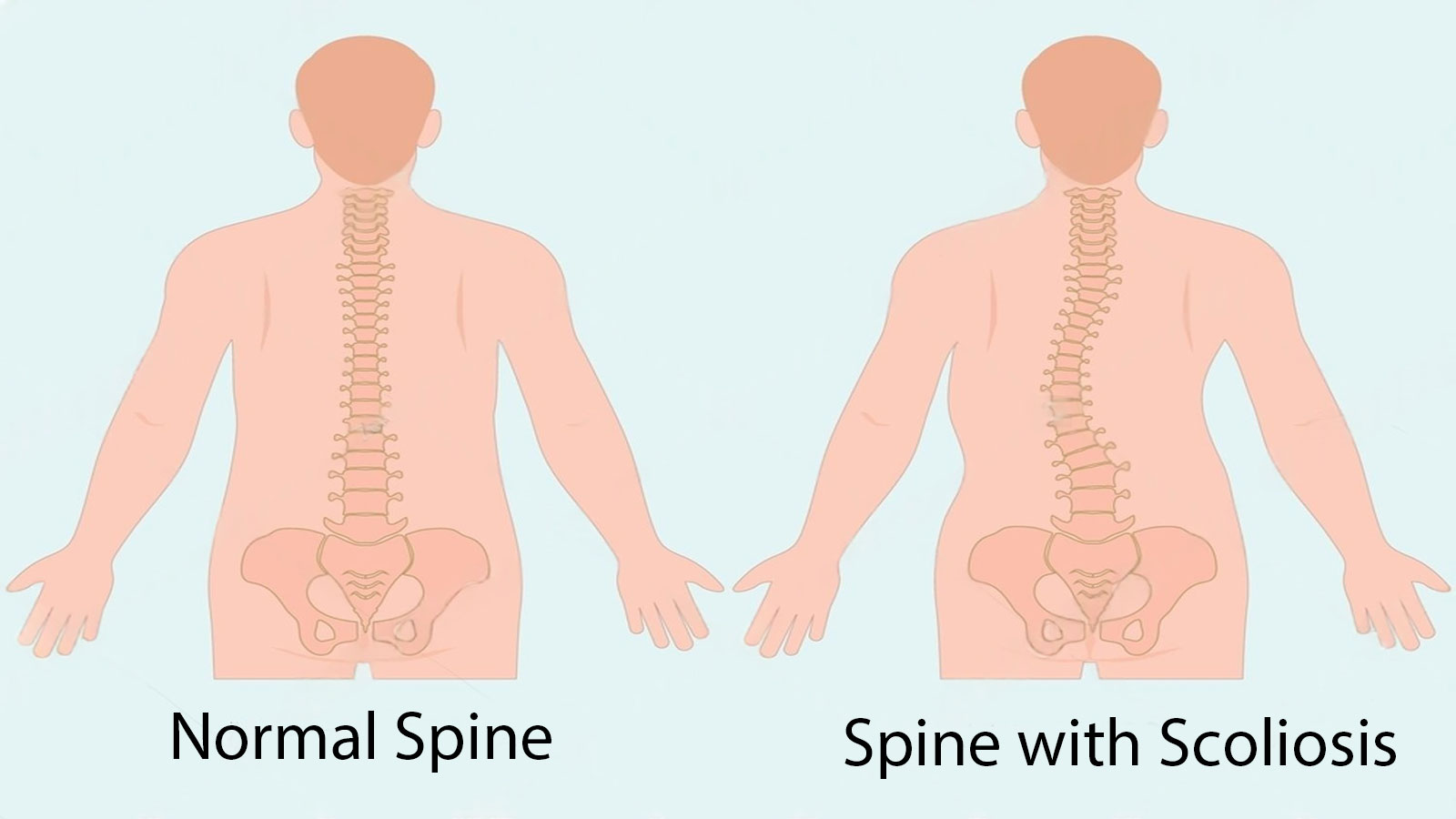Scoliosis and Spine Deformity Surgery in Delhi — evaluation, bracing, and surgical correction