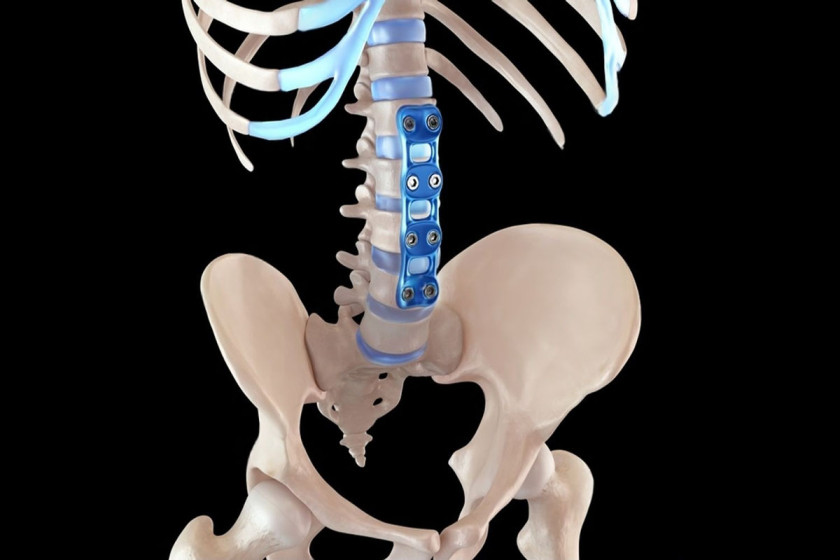 Posterior spinal fusion — scoliosis correction in Delhi